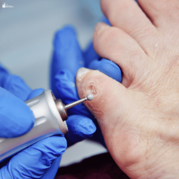 Blue-gloved hands hold a toe while a rotary tool treats thickened skin, a foot problem that can affect elderly adults.